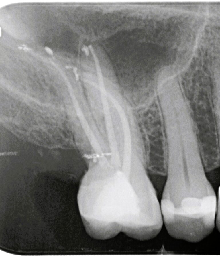 endodoncia