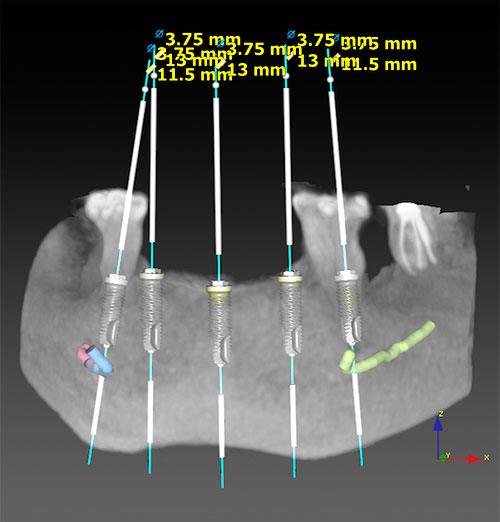 Mandíbula radiología 3D