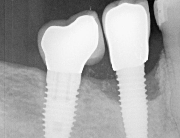 Implante de la izquierda sin ningún problema. El implante de la derecha, esta rodeado de una zona oscura, que indica pérdida ósea. Esta afectado por una periimplantitis, y requerirá tratamiento.